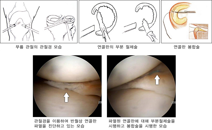 반월상 연골판 절제술 및 봉합술