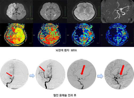 뇌경색 환자 MRA, 혈전 용해술 전과 후