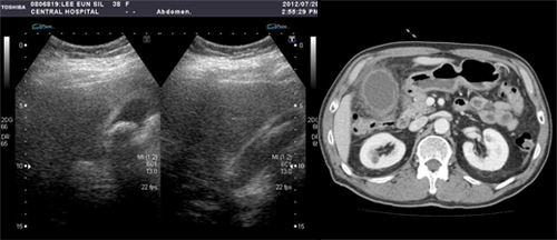 복부 초음파, 복부 전산화 단층 촬영(CT)